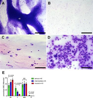 Transcript Analysis Reveals a Hypoxic Inflammatory Environment in Human Chronic Otitis Media With Effusion